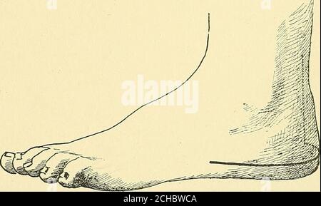 . Textbuch der operativen Chirurgie . n des OS calcis. Ein Längsschnitt wird entlang des inneren Aspekts des TendoAchilis zum unteren und hinderlichsten Teil der grösseren Tuberosität des theos calcis und von der Breite der Ferse und vorwärts entlang des äußeren Aspekts zur Röhrenrosität an der Basis des fünften Metatarsalknochens gemacht. Das gibt dem Träger Raum, wenn die weichen Teile flexibel sind. Der tendo Achilis ist von der hinteren Tuberösenoberfläche abgelöst; die Gelenkkapsel im hinteren und äußeren Aspekt des os calcis, zusammen mit dem Calcaneo-fibulären Band Stockfoto