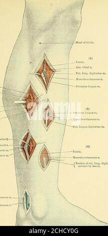 . Textbuch der operativen Chirurgie . owthe Kopf der Fibel unter der Abdeckung des extensor longus digitorum, während der Nervus usculo-kutaneous vertikal nach unten über den gleichen Abstand erstreckt. Der vordere Tibialnerv begleitet in seinem Verlauf die anteriore Tibialarterie in ihrer ganzen Länge und kann durch die gleichen Einschnitte freigelegt werden. Es liegt an der Oberseite der Arterie, außer unten, wo es nach seinem vorderen und inneren Aspekt liegt. Auf der Vorderseite des Beins. Da der Nerv hier die Arterie in ihrer Ganzheit begleitet, wird er in der gleichen Weise wie die Arterie exponiert {q.v.). Belichten Stockfoto