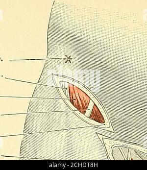 . Text-Buch der operativen Chirurgie . die lokale Anästhesie wird in den Abbildungen im Kapitel über die lokale Anästhesie gezeigt. (6) Der Lange Nervus Saphena. Dieser sensorische Brauch wird auf die Haut auf der Innenseite des Oberschenkels verteilt: Durch ein Terminal Brauch (Ramus infrapatellaris) versorgt es den Bereich vor und unter der Patella, durch das andere versorgt es die Innenseite von Bein und Fuß. Der Nerv begleitet die A. femoralis bis zur Öffnung im Adductormagnus und folgt dem Verlauf der inneren Vena saphena am Knie und im Bein. Exyosure im Oberschenkel. Ligatur Vide Stockfoto