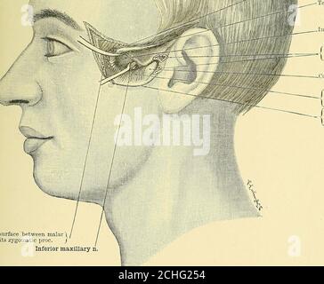 . Text-Buch der operativen Chirurgie . f Schnitt Oberfläche der zeitlichen m.. iwn Oberfläche zwischen malari und seine üygomatic proc. j inferior maxillary n. Temporal m. lufratemporal Kamm. r Sawii Oberflächen von■ die Wurzel des Thezygoms. -Condyle des Kiefers. Fasern von masseterlipon innen sur-face von Zygoma.Oberer Rand von Zygoma turneddown. Abb., 108. – Exposition des Tliirds (unterer Oberkiefer)Teilung des Tlietrigeminalnervesses Foramen ovale. Der Schnitt (Abb. 109) ^ beginnt eine Fingerbreite hinter dem frontalen Prozess des Themalars und wird schräg nach unten und nach hinten in die hintere Extremität des zy getragen Stockfoto