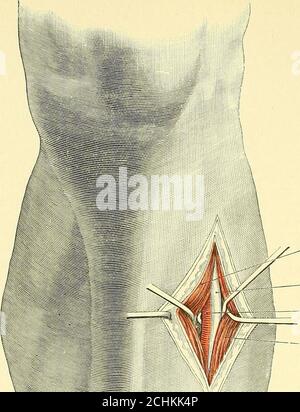 . Textbuch der operativen Chirurgie . Semiinembranosus m.Int. popliteal n.popliteal V. popliteal a. Fascia lata. Äußerer Kopf gastrocnemius m. Innenkopf gastrocnemius ni. Kurze saphena v. Comm. Tibialis n. Kopf der Fibel. Abb. 62. - Ligatur der Arteria poplitea. Des tibialis anticus, zwischen ihm und dem extensor longus hallucis. Der Nervus anteriortibialis liegt auf der äußeren Seite der Arterie. Im unteren Drittel. Am äußeren Rand der Sehne des thetibialis anticus (der ersten großen vorspringenden Sehne, die außerhalb des Vorrandes der Tibia liegt), zwischen ihr und der wird ein Schnitt gemacht Stockfoto