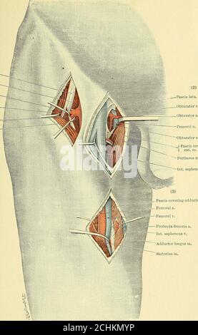 . Text-Buch der operativen Chirurgie . Ligaturing der femoralen Arterie, die Faszie über dem Adductor longus wird internalto die femoralen Gefäße geteilt, Und die Dissektion wird tief entlang der Fasern des Adductor longus zum Knochen hin fortgesetzt, bis zum inneren Aspekt des Vastus internus, dessen Fasern schräg nach unten und nach vorne übergehen. Die Arterie befindet sich an der hinteren anliegenden Kante des Vastus internus unmittelbar oberhalb des oberen Endes Insertions des Adductor longus, unter dem sie nach unten fortgesetzt wird. 73. Ligatur der Arteria circumflex externa. (A) an seinem oder Stockfoto
