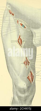 . Text-Buch der operativen Chirurgie. Hinter der Sehne, in Fett eingebettet. Die Vena poplitea liegt posteriorly, und zwischen ihr und den Integuments ist der innere Nervus poplitea. Beim Zurückziehen des Musculus artorius wird der innere saphenöse Nerv freigelegt, begleitet von der oberflächlichen Brauch der Arteria anastomotica magna, die beide nach hinten über den inneren Rand der Sehne des Adductors magnus gehen. (b) von außen. Ligatur der poplitealen Arterie unterhalb der Öffnung in theadductor magnus, im oberen Teil des popliteal Raum, ist leichter efiected von ^ Wir bedauern, dass Anatom Stockfoto