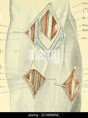 . Text-Buch der operativen Chirurgie . Septum. Der Schnitt (Abb. 44) ist das gleiche wie für die Exposition des Ulnarnerv, die Faszie wird hinter dem intermuskulären Septum geteilt. Die Arterie liegt neben dem Nerv auf den muskulären Fasern des inneren Kopfes des Trizeps. An seinem unteren Ende kann die Arterie auf der hinteren Oberfläche des internalepicondyle gefeit werden, und ist zu sehen, dass sie den ulnar Nerv hinter dem internalintermuskulären Septum begleitet. 37. Ligatur der Arteria collateralis ulnaris inferior (Arteria Anastamotic).die Arterie liegt auf der Basis des inneren Epikondyles über dem Stockfoto