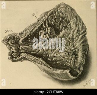 . Erkrankungen des Magens: Einschließlich diätetischer und medizinischer Behandlung. Abb. 16. Magengeschwür auf der kleineren Krümmung in einiger Entfernung vom Pylorus mit umschriebenen Linitisungen, die sich vom Geschwür bis zum Pylorus erstrecken. (Aus Blutgutsammlung von Proben im Sur-gical Pathological Laboratory des Johns Hopkins Hospital.) Abb. 17 Abb. 18 Stockfoto