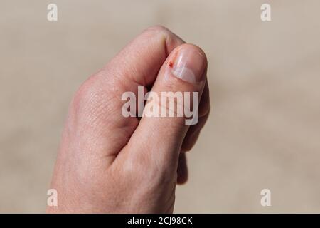 Daumentrauma. Blutung aus einem geschnittenen Finger. Blut von einem Finger. Stockfoto