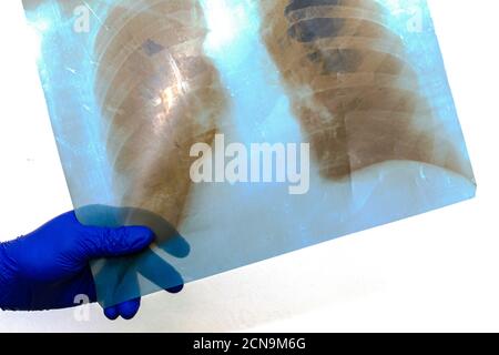Hand in blauem Gummi schützende medizinische chirurgische Handschuh hält Röntgenaufnahmen der menschlichen Lunge Stockfoto