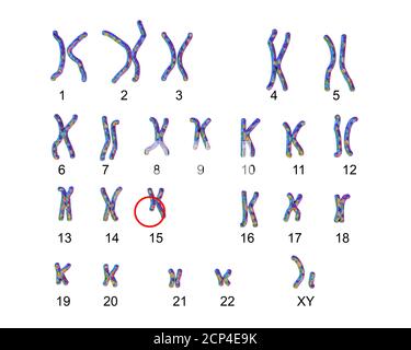 Karyotyp des Angelman-Syndroms (AS), Computerdarstellung. WIE ist eine genetische Störung durch Armschlagen gekennzeichnet, übermäßiges Lachen (auch wenn verletzt Stockfoto