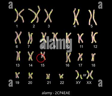 Karyotyp des Angelman-Syndroms (AS), Computerdarstellung. WIE ist eine genetische Störung durch Armschlagen gekennzeichnet, übermäßiges Lachen (auch wenn verletzt Stockfoto