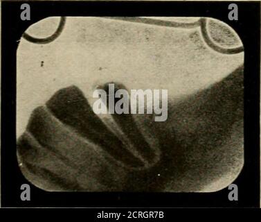 . Elementare und dentale Radiographie / von Howard Riley Raper . Abb. 447A. Der zentrale Schneidezapfen scheint in den Abszess involviert zu sein. Abb. 44 TB. Vergleichen Sie mit Abb. 447Ades gleichen Falles.. Stockfoto