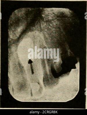 . Elementare und dentale Radiographie / von Howard Riley Raper . Abb. 447A. Der zentrale Schneidezapfen scheint in den Abszess involviert zu sein. Abb. 44 TB. Vergleichen Sie mit Abb. 447Ades gleichen Falles. Stockfoto