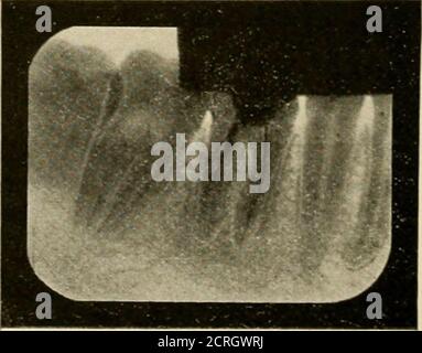 . Elementare und dentale Radiographie / von Howard Riley Raper . Abb. 436 A. Drähte im unteren ersten Molar. Röntgenstrahlen, die diagonal durch den Zahn geführt werden; PfeileNein. 1 und Nr. 2, Abb. 436. Abb. 436B. Gleiche Groß-/Kleinschreibung wie Abb. 4..ii. Nacktbild mit Röntgenstrahlen, die durch den Zahn als mit Pfeil Nr. 3 indi-cated. Abb. 436. Das Wiresin die Mesialkanäle sind während der meisten ihrer Länge überlagert. RE. WING-RÖNTGENAUFNAHMEN 387 Stockfoto