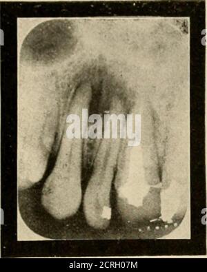 . Elementare und zahnärztliche Radiographie / von Howard Riley Raper . die in die Zellstoffkammer einzutreten scheint. Es wurde daher angenommen, dass die Füllung in die Zellstoffkammer ausdehnt, und diese Diagnose wurde entsprechend gestellt. Gab es eine Erweiterung der. Die Füllung auf die bukkale oder linguale der Form des Materials, Die in diesem Fall in die Pulpkammer gelangt, wäre diese Erweiterung für die Zuführung von Füllmaterial in die Pulpskammer verantwortlich gemacht worden. 23. Anzunehmen. ^ das Auftreten von flachen Röntgenbildern (nicht stereoskopischen Röntgenbildern), die Wurzel eines oberen Pos-Terios Stockfoto