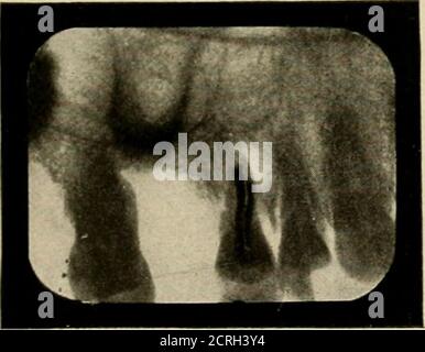 . Elementare und dentale Radiographie / von Howard Riley Raper . Abb. 406. Fall, in dem der coronoide Prozess mit einer Wurzel eines oberen dritten Molars verwechselt wurde. Abb. 405. Röntgenaufnahme des Höckerlingus.. Stockfoto