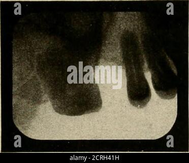 . Elementare und dentale Radiographie / von Howard Riley Raper . Abb. 406. Fall, in dem der coronoide Prozess mit einer Wurzel eines oberen dritten Molars verwechselt wurde. Abb. 405. Röntgenaufnahme des Höckerlingus. Stockfoto