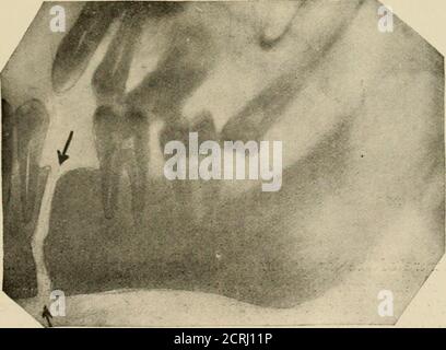 . Elementare und dentale Radiographie / von Howard Riley Raper . Abb. 280. Die Pfeile zeigen auf einen Bruch des Kiefers im Bereich des Winkels. (Röntgenaufnahme von Cole und Raper.) Rig. 281. Die Pfeile zeigen auf einen Bruch des Unterkiefers, der sich unmittelbar hinter dem zweiten Bicus-Pid befindet. Die gegenüberliegende Seite des gleichen Kiefers wurde in Abb. 280.- (Röntgenbild stark neu bearbeitet; (Röntgenbild von Cole und Raper.) 244 ZAHNRADIOGRAPHIE Stockfoto