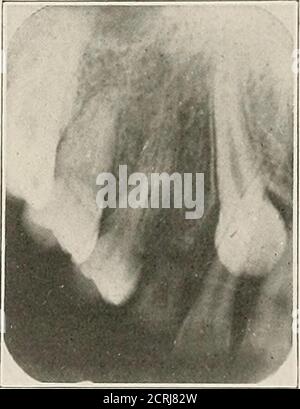 . Interpretation von zahnärztlichen und kieferförmigen Roentgenogrammen . Abb. 222. Abb. 223. Stockfoto