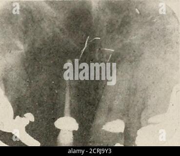 . Interpretation von zahnärztlichen und kieferförmigen Roentgenogrammen . Abb. 214. Abb. 215. Stockfoto