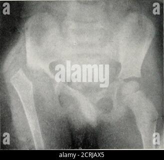 . Radiographie, Röntgentherapeutika und Radiumtherapie . PLATTE WII. - Verletzungen und Erkrankungen des Beckens und Hüftgelenk. A, Bruch des Beckens bei einem Kind; die Verletzung lias trat a1 beide Schambeinknochen, und auf einer Seite durch das Ischium. b, Bruch des Halses des Oberschenkels, Impaktion in großen Trochanter. c, Verschiebung des Ripper Ende des Oberschenkels bei einem Kind. Das Hüftknochen ist erodiert und der Kopf des Femursent. Dies ist wahrscheinlich das Ergebnis von Tuberkulose. Die Erscheinungen sind ähnlich denen der con- gi nii.ll Verengung. ERKRANKUNGEN DES KNOCHENS Alle Arten von Knochenerkrankungen werden in der radiographischen Untersuchung getroffen Stockfoto