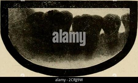 . Elementare und dentale Radiographie / von Howard Riley Raper . Abb. k.o. Abb. 161. Abb. 1(50. Betroffener oberer dritter Molar.Abb. 161. Betroffener oberer dritter Molar. Beachten Sie den in diesem Fall und in Abb. 160. Stockfoto