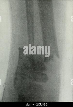 . Die Roentgen Strahlen in der Medizin und Chirurgie als Hilfsmittel in der Diagnose und als therapeutisches Mittel; für den Einsatz von Praktikern und Studenten konzipiert. Abb. 277. Patient von Dr. Gushing. Bruch des unteren Endes der Fibel. In diesem Fall war der linke Knöchel einer Frau von dreißig Jahren stark geschwollen, und es gab auch eine große Schwellung des Beines und Fußes; die Zärtlichkeit begann 6 Zentimeter über der Spitze des äußeren Malleolus. Eine sorgfältige Untersuchung mit den üblichen Methoden war aufgrund von Ödemen und Schwellungen nicht möglich. Es wurden zwei Röntgenaufnahmen gemacht. Der aus der antero-posterioren Ansicht zeigte keine Fraktur; t Stockfoto