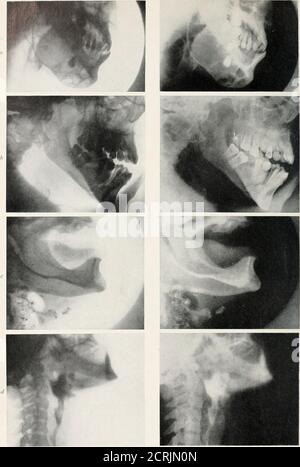 . Radiographie, Röntgentherapeutika und Radiumtherapie . PLATTE III Skills, DIE ABFAHRTEN PROM DIE NORMALE, a, laterale Ansicht von .Skull, zeigt Erosion des Hinterhauptknochens das Ergebnis einer Verletzung mit secondarydisease des Knochens. Beachten Sie große Stirnhöhlen. b, Schädel bei einem Kind, zeigt Formung der Schädelknochen infolge von intrakranialem Druck. c, Schädel aus einem Fall von Tumor des Gehirns, an der sella turcica gelegen; das Detail in der Region ist verloren.. PLATTE IV. - Unterkiefer und Halsbereich. A, Zahnzyste im Unterkiefer (vergrabener Zahn).b, Bruch durch Ramus des Unterkiefers.Schädelbild Stockfoto