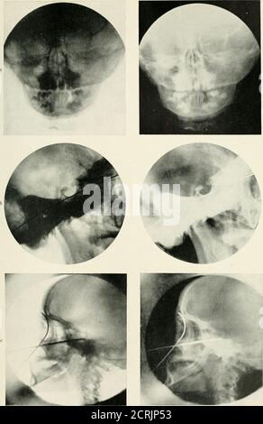 . Radiographie, Röntgentherapeutika und Radiumtherapie . PLG. 106. – Position für die Radiographie der Mastoidsinus. (Pirie). PLATTE [I. – normale Schädel. «, Schädel des Kindes, Platte auf anterior Aspekt zeigt nasale Fossae; Zähne gut dargestellt; es gibt severalunerupted Zähne gesehen. b, Mitte Bereich des Schädels ; eine Linie hat Wen auf Punkte, die die radiographische Basis-Linie platziert ; Die Lineruns durch die Basis der sella turcica (trockener Schädel). c, laterale Ansicht des Schädels im lebenden Subjekt; Sonden wurden in die frontalen und sphenoidalen Sinus platziert. RADIOGRAPHIE DER STIRNHÖHLEN 127-förmige Linie. Diese Krese Stockfoto