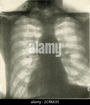 . Radio-Diagnose der pleuro-pulmonalen Zuneigung . Nr. 1389. J. K.bronchi auf der rechten Seite. Röntgenaufnahme für Männer, 15 Jahre alt. Lungentuberkulose Dilatation von. Röntgenbild 16. DILATATION DES BRONCHINO. 101. P. C. Männlich. 35 Jahre. Klinische Anamnese und Untersuchung: Husten; Gewichtsverlust; Schwäche. Hyperresonanz über die ganze Brust, harsch verlängertAtmung. Keine Rales. Röntgenbefund: Emphysem. Allgemeine bronchiale Dilatation. Etwas peribronchiale Verdickung. Stockfoto