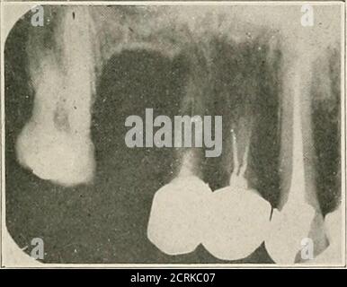 . Interpretation von zahnärztlichen und kieferförmigen Roentgenogrammen . Abb. 22.-C.. Stockfoto