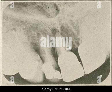 . Interpretation von zahnärztlichen und kieferförmigen Roentgenogrammen . Abb. 22-D. Abb. 22-E. Stockfoto