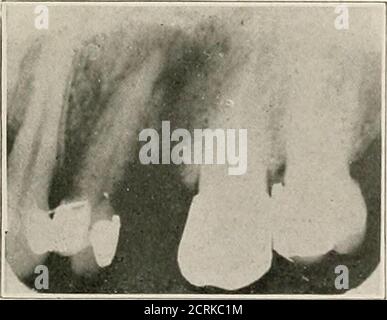 . Interpretation von zahnärztlichen und kieferförmigen Roentgenogrammen . Abb. 22-D. Abb. 22-E.. Abb. 22-R Stockfoto