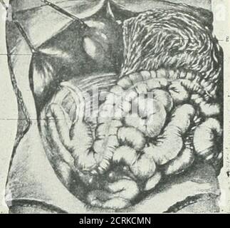 . Archive der Physikalischen Medizin und Rehabilitation . Wig. 4 – Arrested Rotation von intes-Tine: (1.) Leber, (d.) duodenum, &lt;s.i.)Dünndarm, (sp.) Milz, (s.)Magen, (s.F.) Splenix Flexure, (t.c.)seg-nient entsprechend transversecolon, (a.c.) aufsteigenden Dickdarm, (j.)ileocolic Junction, (a.) Blinddarm. 6 – Arrested Rotation von intes-Tine: (1) Leber, (i.) Terminal ileum, (go.) große omentum. (Prom Hunt-ington.) Stockfoto