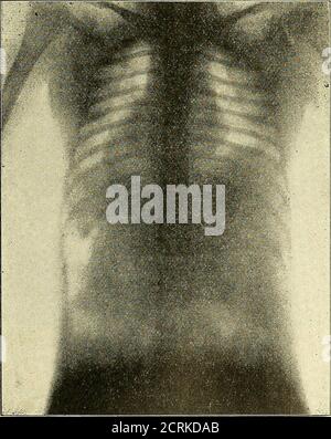 . Klinische und anatomische Untersuchungen über den Cretinismus . Pio-. 43. 182 Iladiologische Untersuchungen.Abb. 44. Stockfoto