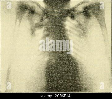 . Klinische und anatomische Untersuchungen über den Cretinismus . Abb. 36.. flach and stehen steil. Der Beckeneingang ist asymmetrisch. Dierechte Beckenhälfte ist kleiner. Das Kreuzbein springt gegen dasBecken vor^ ebenso, jedoch nur wenig angedeutet, die Pfannengesang, Radioiogische Untersuchungen.Abb. 37. 177 Stockfoto