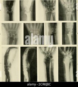 . Radiographie, Röntgentherapeutika und Radiumtherapie . PLATTE XIII. – Frakturen im Unterarm, Handgelenk und Hand. A, Fraktur der terminalen Phalanx des Tliunib, Rückwärts-Verschiebung. Laterale und antero-posteriore Ansichten. b, Bruch des Trapezes. c, Bruch durch unteres Ende der Welle des Radius, sehr geringe Verschiebung. d, nicht-Union Bruch des Radius und Ulna, Bildung von falschen Gelenken.. PLATTE XIV. – Fraktdres am Handgelenk. Fraktur des unteren Radiusendes, a, laterale Ansicht mit Verschiebung, b, antero-posteriore Ansicht mit Art der Fraktur. c, antero-posteriore Ansicht der getrennten Epiphyse des unteren en Stockfoto