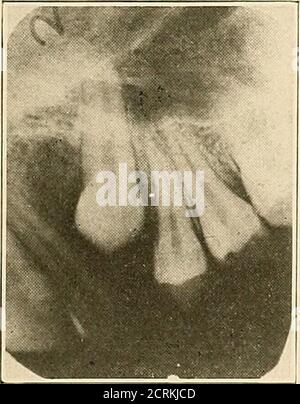 . Interpretation von dentalen & kieferförmigen Roentgenogrammen . Abb. 220. Abb. 221. Stockfoto