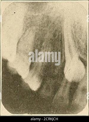 . Interpretation von dentalen & kieferförmigen Roentgenogrammen . Abb. 222. Abb. 223. Stockfoto