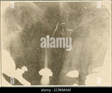 . Interpretation von dentalen & kieferförmigen Roentgenogrammen . Abb. 214. Abb. 215. Stockfoto