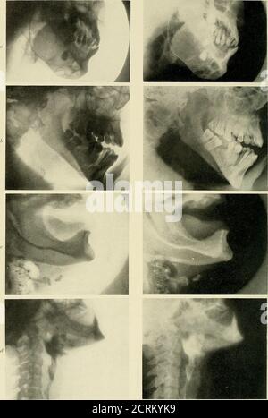 . Radiographie, Röntgentherapeutika und Radiumtherapie . PLATTE III. - Schädel zeigt Abgänge von der Normalität. A, Seitenansicht des Schädels, zeigt Erosion des Hinterhauptknochens das Ergebnis einer Verletzung mit sekundärer■-Erkrankung des Knochens. Beachten Sie große Stirnhöhlen. b, Schädel bei einem Kind, zeigt Formung der Schädelknochen infolge von intrakranialem Druck. c, Schädel aus einem Fall von Tumor des Gehirns, an der sella turcica gelegen; das Detail in der Region ist verloren.. PLATTE IV. - Unterkiefer und Gebärmutterhals Region. A, Zahnzyste iu Unterkiefer (vergrabener Zahn).6, Bruch durch Ramus des Unterkiefers.Schädelbild Stockfoto