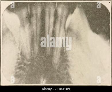 . Interpretation von dentalen & kieferförmigen Roentgenogrammen . Abb. 164. Abb. 165. Abb. 164. - untere rechte zentrale und laterale Schneidezähne in der Mitte des Films; Pulps vital, Knochen normal. Abb. 165. – untere mittlere und seitliche Schneidezähne, normal. INTERPRETATION DES ROENTGENOGRAMS 111 Lower Front Region Stockfoto