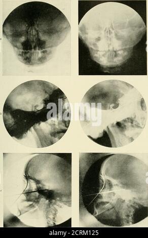 . Radiographie, Röntgentherapeutika und Radiumtherapie . Abb. 106.- -Positioii für Nidiograpliy der Mastoidsinus. (Pirie). PLATTE II. – normale Schädel. a. Schädel des Kindes, Platte auf anteriorem Aspekt, der nasale Fossae zeigt; Zähne gut gezeigt; es gibt severaliinerupted Zähne gesehen. 6, Mittelbereich des Schädels; eine Linie wurde auf Punkten platziert, die die radiographische Grundlinie geben; die Lineruns durch die Basis der sella turcica (trockener Schädel). c, Seitenansicht des Schädels in lebendem Subjekt; Sonden wurden in den frontalen und sphenoidalen Sinus platziert. RADIOCJKAPHY DER STIRNHÖHLEN 127-förmige Linie. Tliis Stockfoto