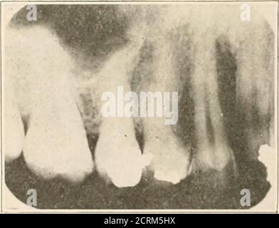 . Interpretation von dentalen & kieferförmigen Roentgenogrammen . Abb. 124. Fie 12S. Abb. 124. – Oberer linker Eckzahn und erster und zweiter Prämolar. Pulps vital. Normalperikemental Linie um Wurzeln gesehen. Auch der Boden der Kieferhöhle ist abgebildet. Abb. 125. – Keine periapikalen Anomalien. Apices des zweiten Prämolars und des ersten Molarens sehr nahe am Boden der Kieferhöhle. INTERPRETATION DES ROENTGENOGRAMS 101 Upper Left Region Stockfoto