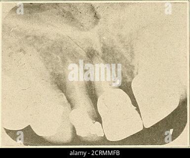 . Interpretation von dentalen & kieferförmigen Roentgenogrammen . Abb. 22-D. Abb. 22-5. Stockfoto