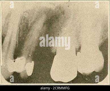 . Interpretation von dentalen & kieferförmigen Roentgenogrammen . Abb. 22-D. Abb. 22-5.. Abb. 22-F. Stockfoto