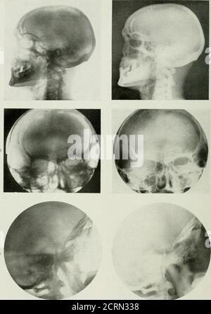 . Radiographie und Radiotherapie . &gt; &gt; a. ILATK XV. – Nor.Mai, Schädel. A, laterale Ansicht des normalen Schädels, sliowiiig frontale Sinus, Sphenoidale Sinus, sella turcica, Temporale Knochen, Halswirbel;, Und Unterkiefer. b, Antero-posteriore Ansicht des erwachsenen Schädels, gleitendem frontalen Nebenhöhlen, Orbits, nasale Fossa-, Antra, etc. Frontalsinus auf der linken Seite ist opaijue. c, laterale Ansicht des Schädels zu Tlie sella turcica zeigen, Artikulation der Wirbelsäule zu Schädel ; Tlie tcmporo-niaxillaryaryaryarticulation auf einer Seite ist gut zu sehen. RADIOGRAPHIE DER NEBENHÖHLEN 209 Stockfoto