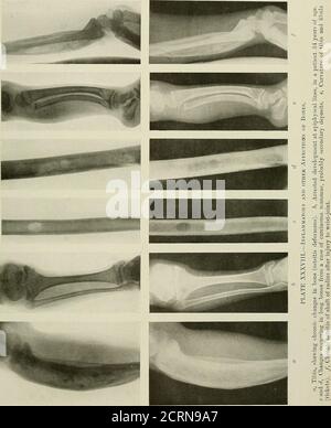 . Radiographie und Radiotherapie. Itis, wahrscheinlich tuberkulös, im Ursprung. Ist in Abb. 226. Die Krankheit kann sich in der Wirbelsäule nach Typhus-Fieber zeigen. Das Gelenk in der Nähe des Knochens kann beteiligt werden. (Siehe Platte XXXIX. d.) Tuberkulöse Erkrankung des Knochens. - Diese Form der Erkrankung des Knochens ist häufig mit in Röntgenuntersuchungen getroffen. Knochen können bei zwei Tagen von Tuberkulose betroffen sein. Das Periost oder das Krebsgewebe kann primär beteiligt sein. Tuberkulöse Periostitis, oder spezifische Entzündung des Periostums, ist mit. Kaseation und Epuration werden wahrscheinlich folgen, Freq Stockfoto