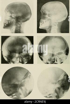 . Radiographie und Radiotherapie . O ca a &lt;. PLATTE XV. - normale Skdlls. A, laterale Ansicht des normalen Schädels, mit frontalen Sinus, Sphenoidalen Sinus, sella turcica, Schläfenknochen, Halswirbeln, Und Unterkiefer. b, Antero-posteriore Ansicht des erwachsenen Schädels, mit frontalen Nasennebenhöhlen, Orbits, nasalen Fossaa, Antra, etc. Frontalsinus auf der linken Seite ist undurchsichtig. c, laterale Ansicht des Schädels, um die sella turcica zu zeigen, Artikulation der Wirbelsäule zum Schädel; die temporo-maxillaryaryartikulation auf einer Seite ist gut zu sehen. RADIOGRAPHIE DER NEBENHÖHLEN 209 Stockfoto