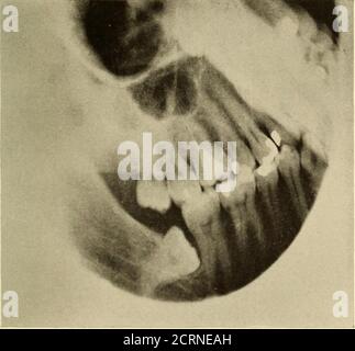 . Orale Roentgoenologie : eine Roentgen Studie der Anatomie und Pathologie der Mundhöhle . Abbildung 40. Abbildung 41.. Abbildung 42. 6o ORALE ROENTGOENOLOGIE Roentgoenologie von nicht erupten und betroffenen Zähnen Abbildung 43. Patient: Herr R. B. F. Geschichte: Hatte wiederholt Probleme mit dem linken unteren Weisheitszahn. Der Brustanfall war der schlimmste, begleitet von großer Schwellung, Schluckbeschwerden, Trismus der Kiefermuskulatur und Eiter-Ausfluss um den Zahn. Roentgen-Untersuchung: Zeigt einen betroffenen unteren dritten Molar mit großer Kavität in der Krone, offenbar mit der Pulpe und verursacht anapikalen Abszess, wie angegeben Stockfoto