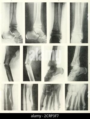 . Radiographie, Röntgentherapeutika und Radiumtherapie . PLATTE XX. – Fractcbes am Knöchelgelenk. a. Schräge Fraktur durch unteren eud der Fibula, (a) Lateral, iji) Antero-posterior Ansichten h. Bruch der inneren und äußeren Malleoli, Verschiebung des Fußes nach außen am Aukle-Gelenk. c. Fraktur des Astragalus. d. Frakturdislokation am Aukle-Gelenk. E, Fraktur unteres Ende der Fibel.. PLATTE XXI. - Fractokes ok Bein, Knöchel und Fuß. ff, Oblique Fracture of Shaft of Tibia, lateral view, zeigt Epiphysen des unteren Endes der Tibia anil al.so OFOS calcis. b, Antero-posterior view of Tibia and filmln, showing an ob Stockfoto