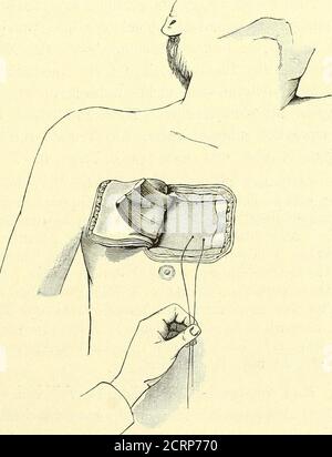 . Grundriss der Lungenchirurgie . Abb. IG... Abb. 17. Temporäre Resektion der Thoraxwand mit Fixationder Lunge. 52 C. Garre. Eines türkisartigen Lappens mit äusserer Basis liegt eigentlich bei Echinokken, Neubildungen, Verletzungen und Fremdkörpern derLunge die Indikation vor, während bei allen zusätzlichen Prozessen muss unbedingt besucht werden. Auch zur Dekoration der Lunge, ein Verfahren, das hin undwieder verwenden wird, hat Delorme einen Hautmuskel-knochenlappen temporär aufgeklappt. Nun folgt die Pleurotomie. Bei verwachsener pleura erledi Stockfoto